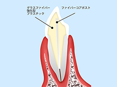 【ファイバーコア】