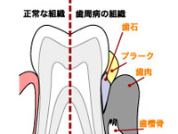 知っておきたい歯周病の原因