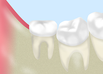 親知らずが痛んだら、早めにご相談ください
