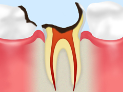 C4 【歯根まで達した虫歯】
